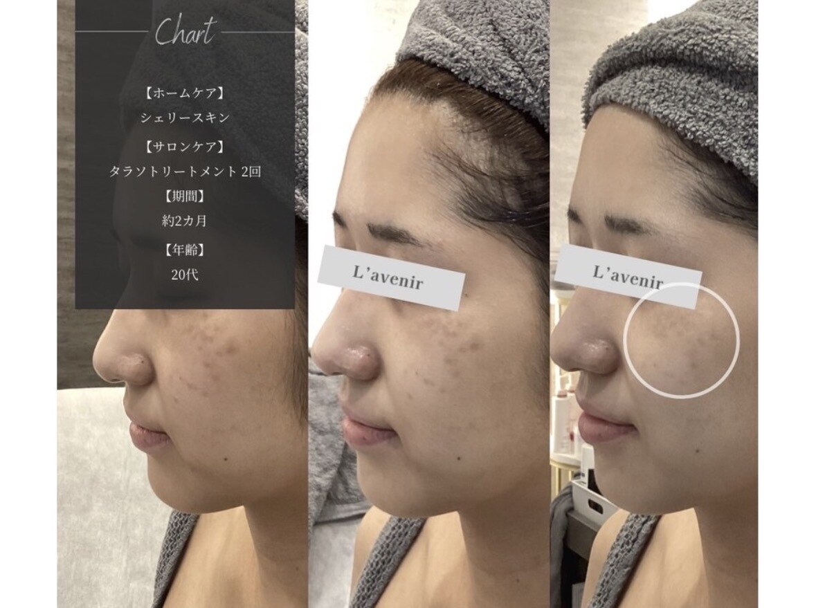 エレクトロポレーション　エステ ハイドロスキンゼニス（毛穴洗浄） ＋ エレクトロポレーション