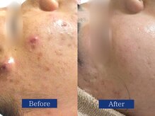 ニキビ改善症例★くり返すニキビに終止符！再発しない肌へ