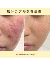 ピーナップ(P-nap)/ニキビ10代