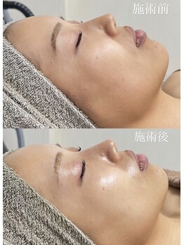 クレヴィー(Creviy)/シルク入りハーブピーリング