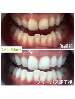 ルブラン 奈良店(Le Blanc)/黄ばみ取れました(^_^)