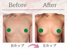 メディカルサロン エム エム エム 大阪梅田グランドサロン(M.M.M)/【バストアップ例】　B→Dカップ