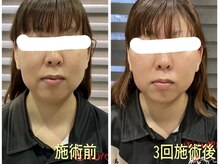 マーガレット整体/微弱電流フェイシャルの施術前後