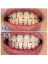 実夢(miyu)/美容ジェル・ビフォーアフター