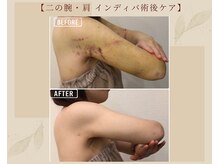 オキシー グレイス 黒崎店(OXY Grace)/二の腕術後インディバ