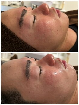 サロン ド グランツィア(salon de Granzia)/20代男性☆毛穴・赤ら顔