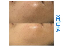 シューラディアント(ShuRadiant)/韓国セラピール