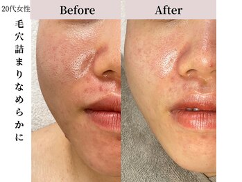 ヴィタベラ(Vita Bella)/VERUNAハーブピーリリング