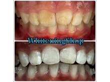 ホワイトニングショップ 武蔵小杉店/【BeforeAfter】9回 施術後比較