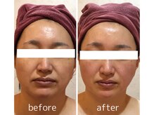 カロン(Kalon)/小顔・リフトアップはお任せあれ