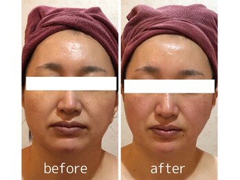 カロン(Kalon)/小顔・リフトアップはお任せあれ