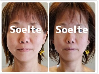 ソエルテ(Soelte)/小顔矯正