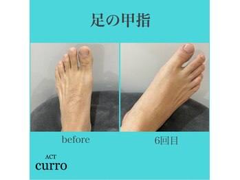 アクト クロ(ACT curro)/【足の甲指】脱毛施術例