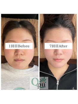 キュープ 大分店(Qpu)/継続で更に小顔へ