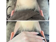 ミース 江坂店/ うなじ●ビフォーアフター