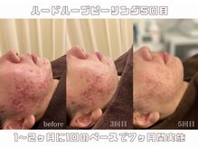 アイル 天王寺店(iru)の雰囲気（剥離ありハーブピーリングで肌質改善しませんか？★）