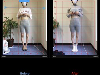 あき鍼灸整骨院/姿勢/O脚X脚/産後骨盤矯正