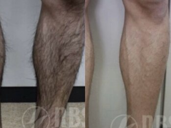 ヴィオール 名古屋栄店(VIOR)/【メンズ脱毛】 足