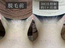 ベルフィーヌ 恵比寿店(BELFINE)/脱毛3回照射後の変化