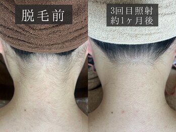 ベルフィーヌ 恵比寿店(BELFINE)/脱毛3回照射後の変化