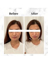 ザビューティー 麻布十番本店(The Beauty)/12Dリフト全顔打ち放題[リフト]