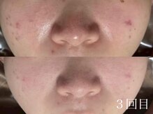 ホワイトアクア 中目黒店(WHITE AQUA)/ララピール/美白ケア/中目黒