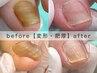 自分で切れない♪【 変形・分厚い爪1指 】深爪のお悩みも◎初回爪切り無料