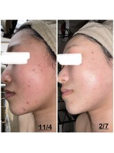 ミニョン(mignon)/ニキビにお困りの方必見！