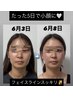 【石巻初】脂肪分解フェイシャル｜小顔・二重あごケア7,000円