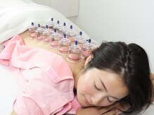 リアン鍼灸接骨院/カッピング　肩こり/腰痛