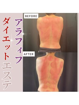 ルールー(Lulu)/背中一面肉はぎ×矯正