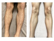 ラナンス 千早(LANUNCE)/足脱毛