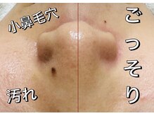 サラン(SALON)/鼻　ビフォーアフター