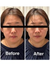 ラキネイ 目黒(Lakinei)/小顔にはテラボーラー◎