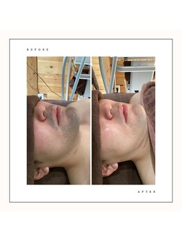 シュエット(Chouette)/メンズ ヒゲ脱毛