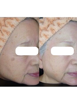 エステティックサロン ドゥネール/【2年間、月に一回】シミケアー