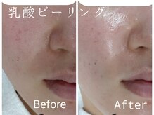 ビー ピボット店(Bee)の雰囲気（人気の乳酸ピーリングで透明感アップ！ニキビ、シミにオススメ☆）