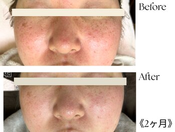 ウィズマツオカ 光の森店/シミがみるみる薄く！？