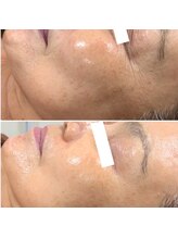 ラダ(RADA)/ハーブピーリング/しみ/ニキビ