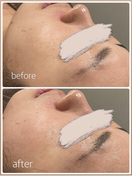 カイト(Kaito)/ハーブピーリング