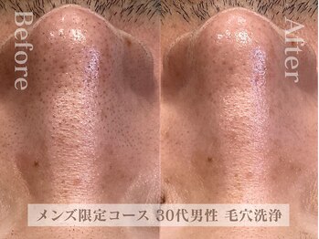 ディレイア ザ コスメ 有楽町マルイ店(direia the cosme)の写真/メンズ限定【ザラザラ毛穴・たるみ改善・ツヤ肌SPECIAL】エステ初めての方も◎[有楽町/メンズ/毛穴/小顔]