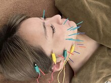 松戸駅前鍼灸院 整骨院/美容鍼＋低周波