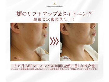 アルモ(ALMO)/フェイスラインのもたつき解消！