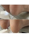 【人気】角質ケア