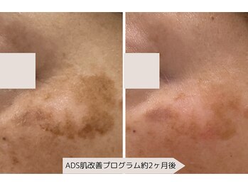 ユーブルーム(youbloom)/ADSで肌改善☆