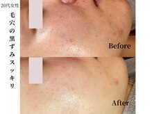 ヴィタベラ(Vita Bella)/VERUNAハーブピーリリング