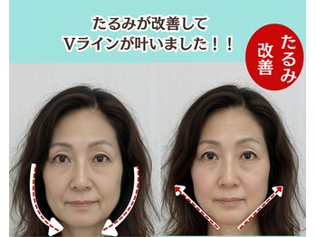 ピュアハリ/沖縄美容鍼 効果