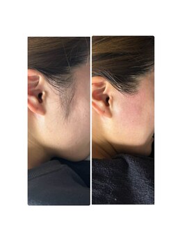 サロンドアメソン(Salon de AMESON)/もみあげW脱毛(ワックス+光)