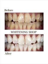 ホワイトニングショップ 福岡香椎店/美容ホワイトニング