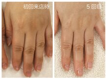 キレイテ 福岡天神店/40代/5回目【博多ハンドケア】